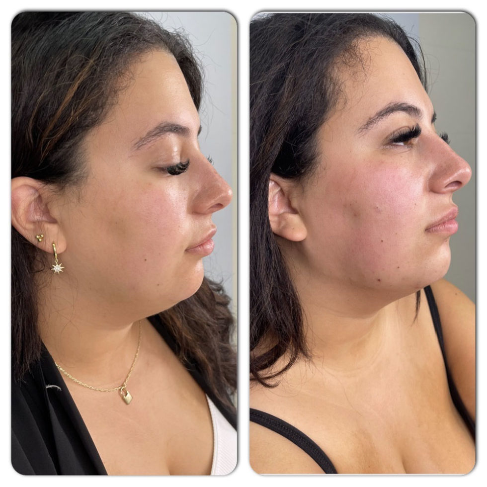 Botox Before And After In Scottsdale Arizona Botox Photos 6617