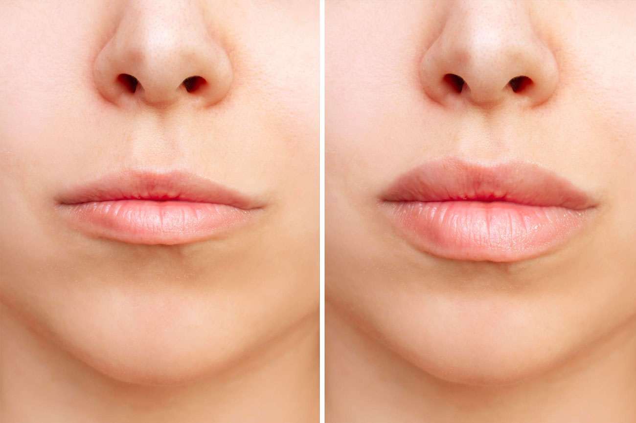 botox-and-fillers-before-and-after