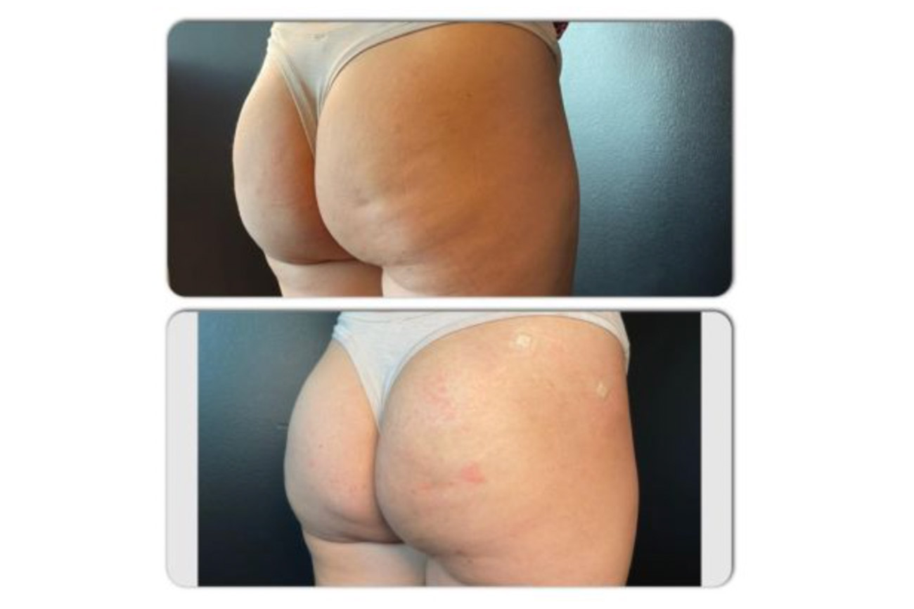 Best Hyaluronic Butt Filler Hip Enlargement Body Filler for Hip